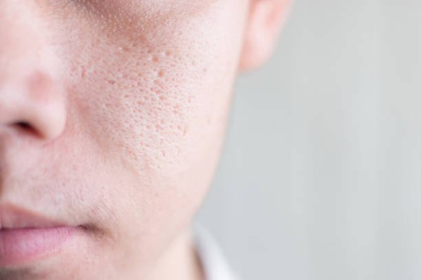 Home Remedies for Open Large Pores