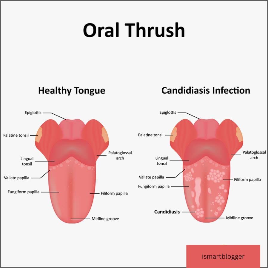 Best Home Remedies for Oral Thrush - iSmartBlogger